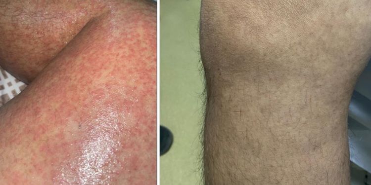 Article: Deficiency of Adenosine Deaminase Type 2 (ADA2) DADA2 Masquerade as Lupus 